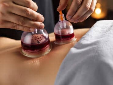 Tasteful close-up of a cupping treatment